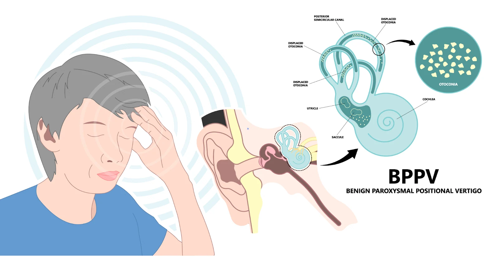 Illustration of benign paroxysmal positional vertigo (BPPV) and the inner ear
