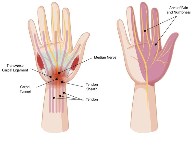 Diagram of the carpal tunnel showing the median nerve and areas of pain and numbness
