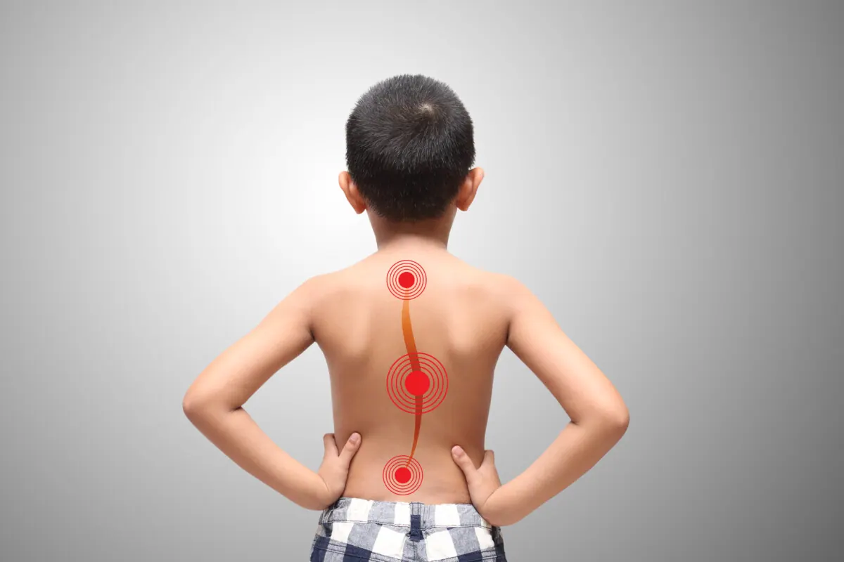 Back view of a boy with a curved spine marked along his back