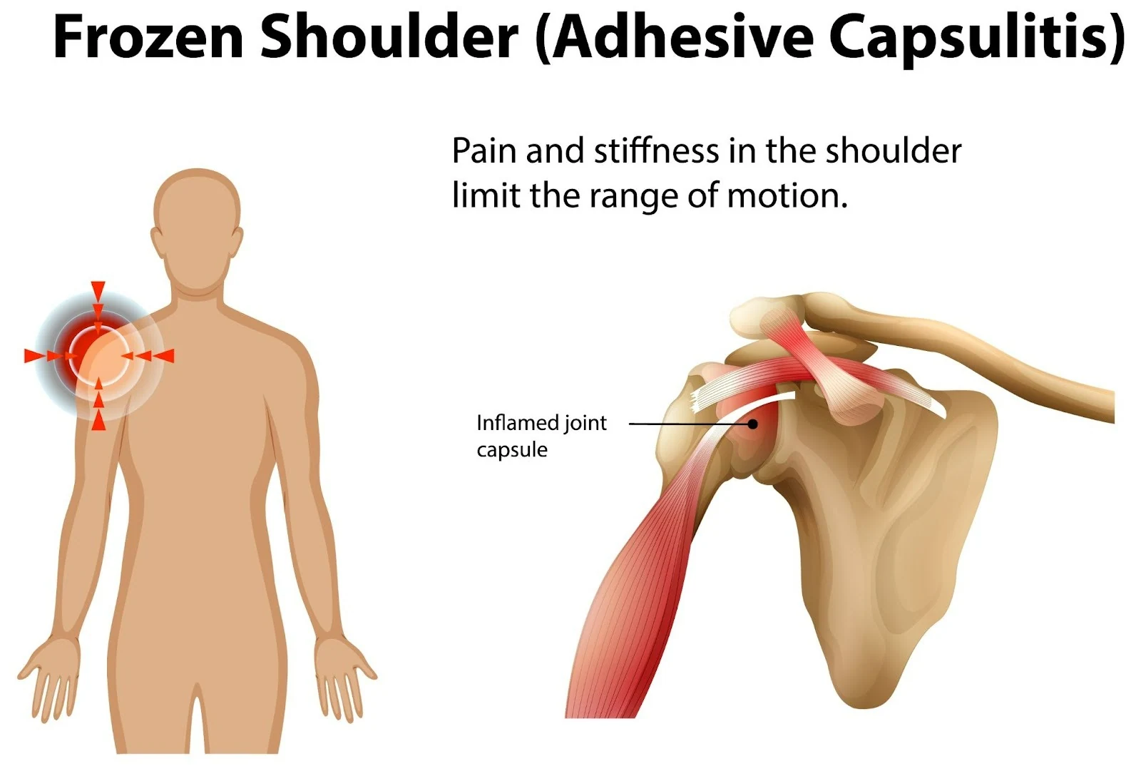 Diagram of frozen shoulder (adhesive capsulitis) showing the inflamed joint capsule