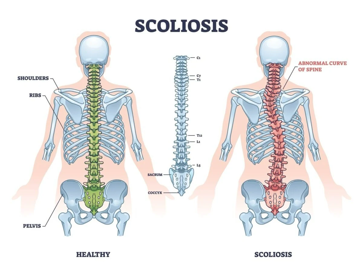 Diagram comparing a healthy spine with a spine curved by scoliosis