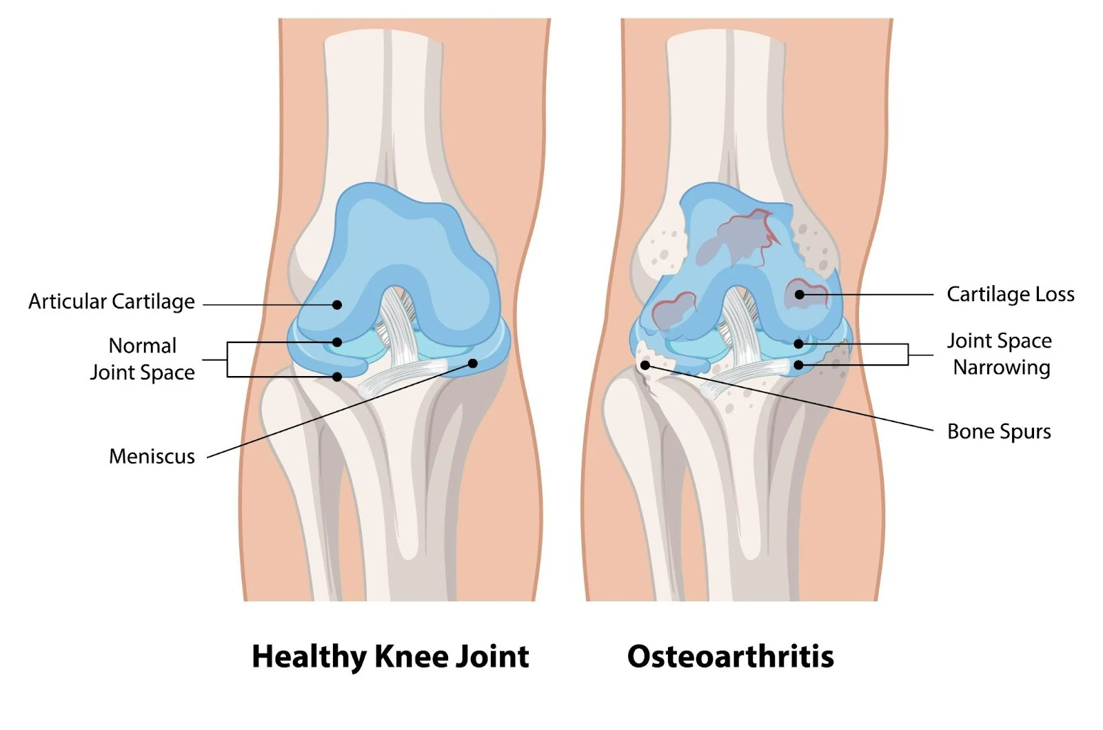 Diagram comparing a healthy knee joint with an osteoarthritic knee