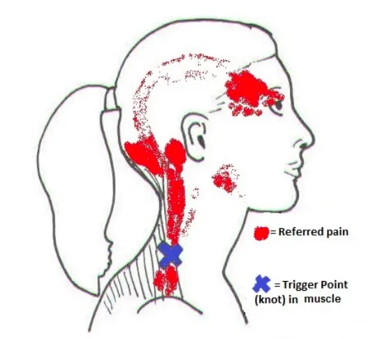 Neck Pain: A Common Migraine Companion