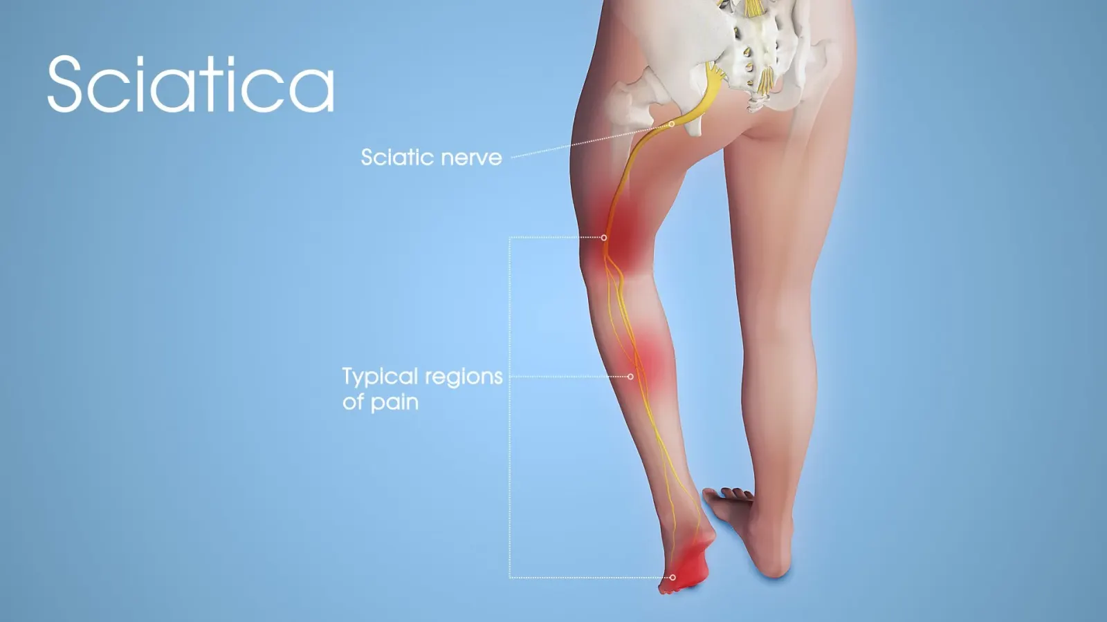Sciatica treatment in Fargo, ND