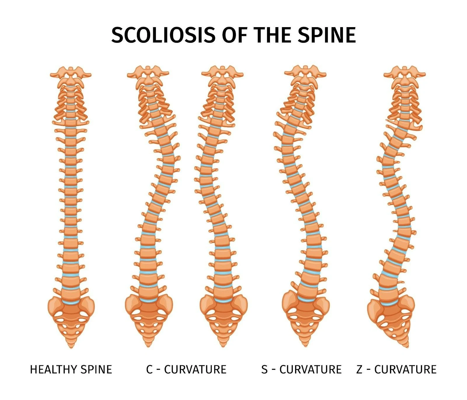 Illustration of a healthy spine beside C-curve, S-curve and Z-curve scoliosis