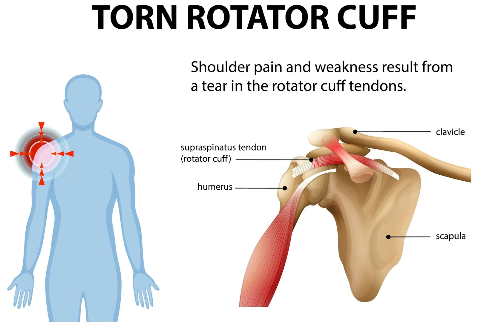 Diagram of a torn rotator cuff showing the shoulder tendons and bones