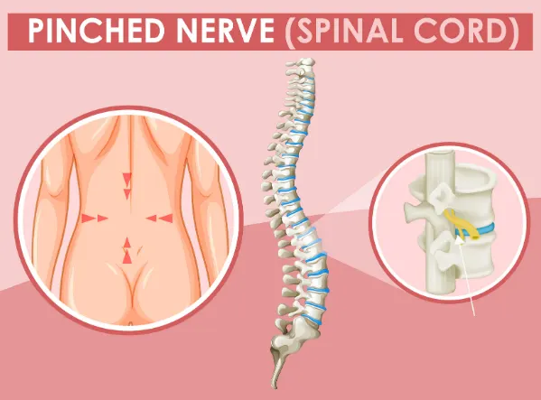 What Causes a Pinched Nerve & How Chiropractic Can Help