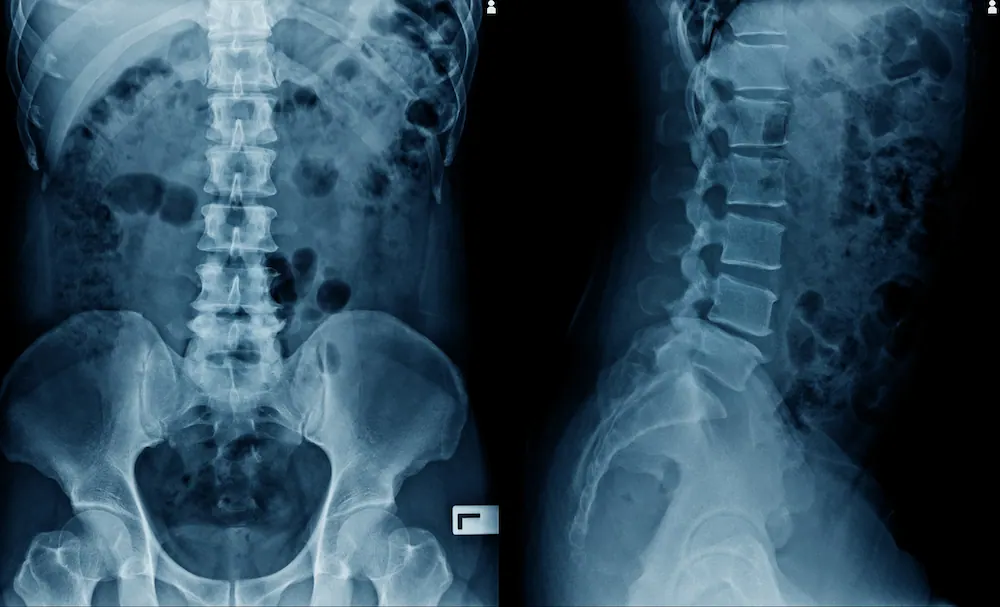 Front and side X-ray views of the lower spine and pelvis